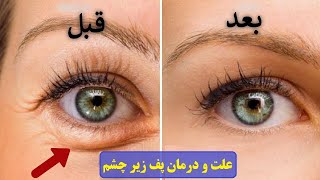 علت پف دور چشم درصبحگاهی چیست و چگونه میتوان آن رو درمان کرد؟