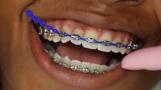 Watch BEFORE Getting POWER CHAIN on your braces..