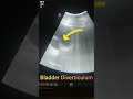 Bladder Diverticulum || Urinary bladder Abnormality || UTI ||Ultrasound || Pelvic Scan || Prostate