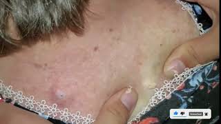 Acne and blackheads 2021 Part 34 || 痤瘡和黑頭 2021 Part 34