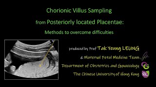 CVS from Posteriorly located Placentae: Methods to overcome difficulties | OBG CUHK