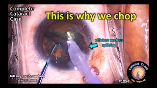 CataractCoach 1054:  Why we chop - complete cataract case