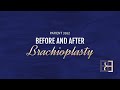 Brachioplasty (Arm Lift) Post Weight Loss {Patient 3162} Before & After