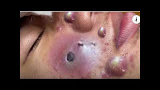 #105. Blackheads treatment 2021 | CYSTIC ACNE ON FACE