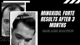 Minoxidil Regroe Forte 6% | Results After 3 months  | Hair Loss Solution