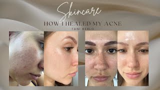 How I healed my acne - Skincare routine
