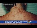 Department Of Health Warns of Sea Lice Outbreak