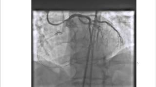 Problem Solving In Antegrade dissection_Re-entry CTO interventions