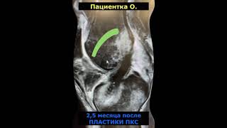 ПЛАСТИКА ПЕРЕДНЕЙ КРЕСТООБРАЗНОЙ СВЯЗКИ - КОНТРОЛЬНЫЙ ОСМОТР ПАЦИЕНТОВ, СНИМКОВ (НИКОЛАЙ ГНЕЛИЦА)