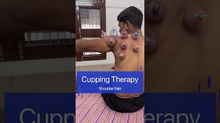 Cupping short video | cupping therapy for back pain| hijama #shorts #shortvideo #cupping