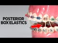 All About Posterior Box Elastics, PBE  https://www.straightsmilesolutions.com/