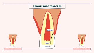 How to manage a tooth fracture ??  Crown-Root Fracture