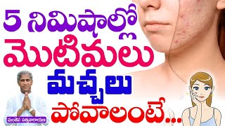 5 నిమిషాల్లో మొటిమలు మచ్చలు పోవాలంటే| Manthena Satyanarayana Raju Videos | Health Mantra |