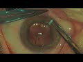 tecnis symfony iol scleral fixation technique by prof. d. zhaboedov