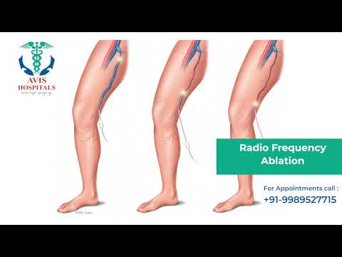 Advance Laser Varicose Veins Treatment In India - YouTube