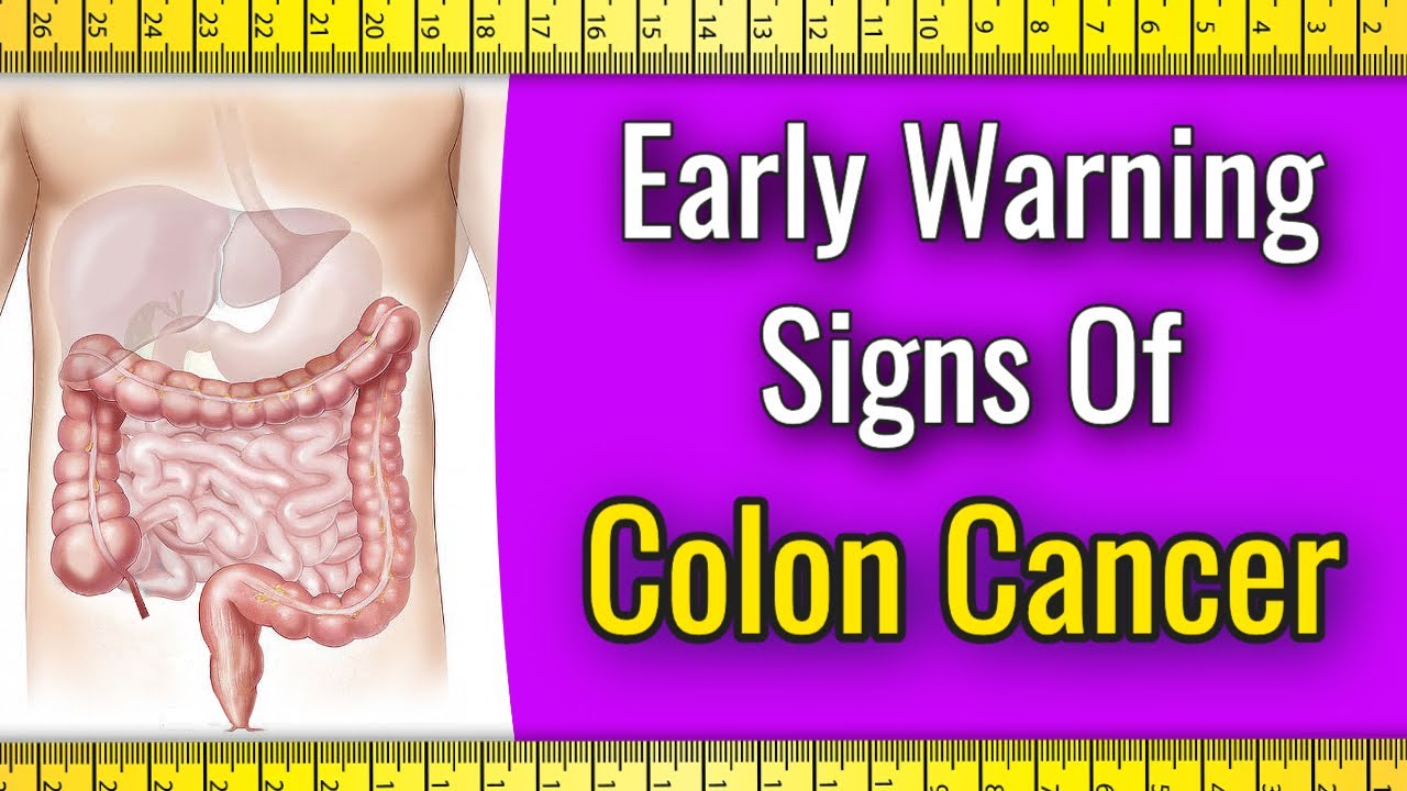 Early Warning Signs Of Colon Cancer - YouTube