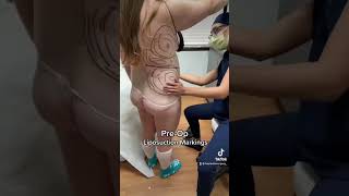 Liposuction Pre-Op Markings 😍