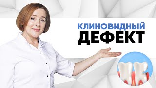 Клиновидный дефект. Что, если не лечить клиновидный дефект? Пришеечный кариес, что делать?Болит зуб.