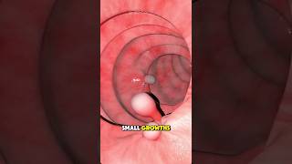 How Colon Polyps Are Removed – Polypectomy Explained