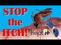 Amazing Insect Bite Itch Remover!  Heat-It Product Review