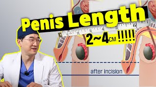 Penis Lengthening Surgery - Common Q\u0026A with A Urologist