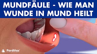 MUNDFÄULE - Wie man Wunde in Mund heilt ©