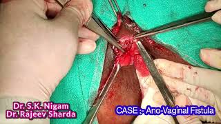 Ano-Vaginal Fistula