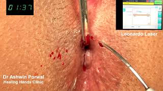 Laser surgery for fissure and external thrombosed piles in 2Mins.