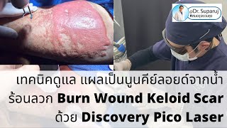 เทคนิคดูแล แผลเป็นนูนคีย์ลอยด์จากน้ำร้อนลวก Burn Wound Keloid Scar ด้วย Discovery Pico Laser