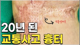 교통사고 후 골절로 치료 중에 염증으로 인해 피부 괴사 / 20년 된 교통사고 흉터