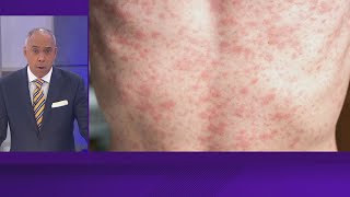 More than 120 measles cases reported in South Plains region of Texas