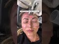 CO2 Laser for Skin Around the Eyelids | Butterfly Lift with Dr. Kami Parsa