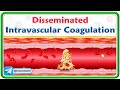 Disseminated Intravascular coagulation (Animation)  : Pathogenesis, Morphology, Diagnosis, Treatment