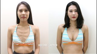 瘦沒有用？男人都看這裡！內視鏡水滴隆乳 | 淨妍醫美