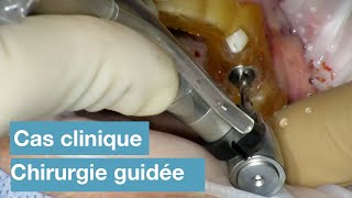 Cas clinique : implantation en chirurgie guidée réalisée en flux numérique