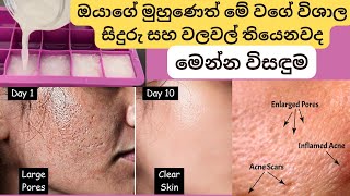 කුරුලෑ නිසා ඇති වුනු මුහුණේ වලවල් සිදුරු නිසා පීඩා විඳින වද මෙන්න විසඳුම | prone skin | dark spots