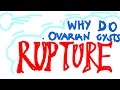 Why Do Ovarian Cysts RUPTURE? What You Should Know | Cause #1