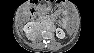 Erdheim - Chester disease - Non-Langerhans Histiocytosis - highly possible diagnosis.