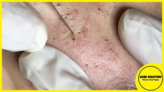 Suri Job 66: AMAZING BLACKHEADS FIELD