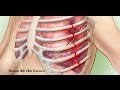 Rib fractures and rib belts