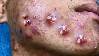 Big Cystic Acne Blackheads Extraction Blackheads & Milia, Whiteheads Removal Pimple Popping