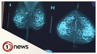 Modified gene could reduce breast cancer risk - global study