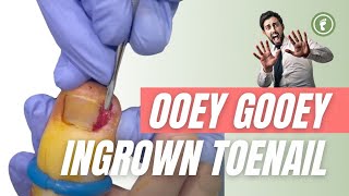 OOEY GOOEY 🪛 INGROWN TOENAIL