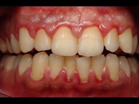 Home remedies to reduce gum swelling | how to reduce gum swelling Home remedies to reduce gum swelling | how to reduce gum swelling