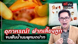 อุทาหรณ์! ฝากเลี้ยงลูกจนฟันน้ำนมผุหมดปาก | สติข่าว | ข่าวช่องวัน | one31