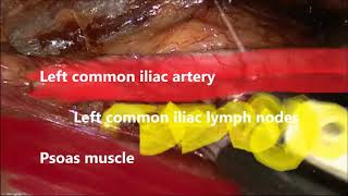 Laparoscopic extraperitoneal lumboaortic lymphadenectomy in 10 steps – let`s make it easier