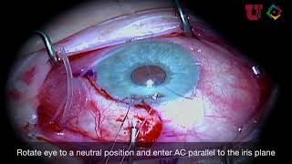 Glaucoma Ahmed Tube Shunt