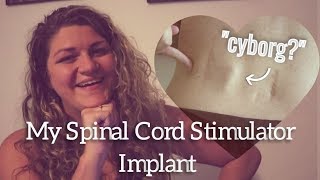 Nevro Spinal Cord Stimulator Implant Surgery (at 21 Years Old) | Young Chronic Pain [CC]