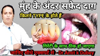 Muh ke Andar Safed Daag। White Patches in  Mouth। How To Cure It ?