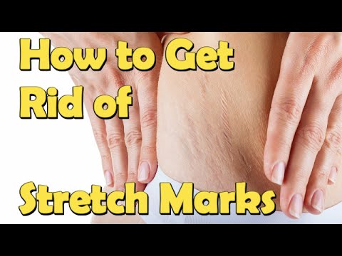 How to Get Rid of Stretch Marks For Teenagers Fast At Home How to Get Rid of Stretch Marks For Teenagers Fast At Home